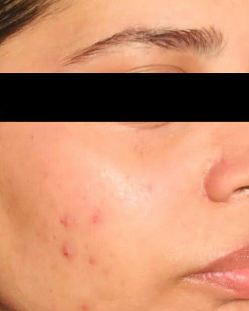 After using Pineapple AHA BHA Spritzer